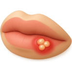 ¿Qué llaga aparece en los labios?